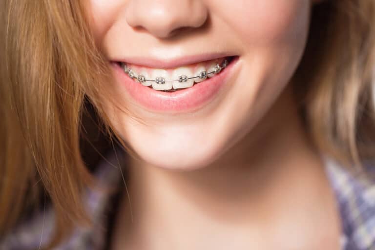 A child with braces.